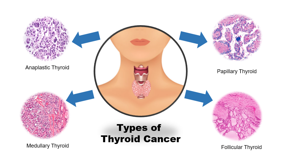 Thyroid Cancer Symptoms Types Causes And Treatment Overview