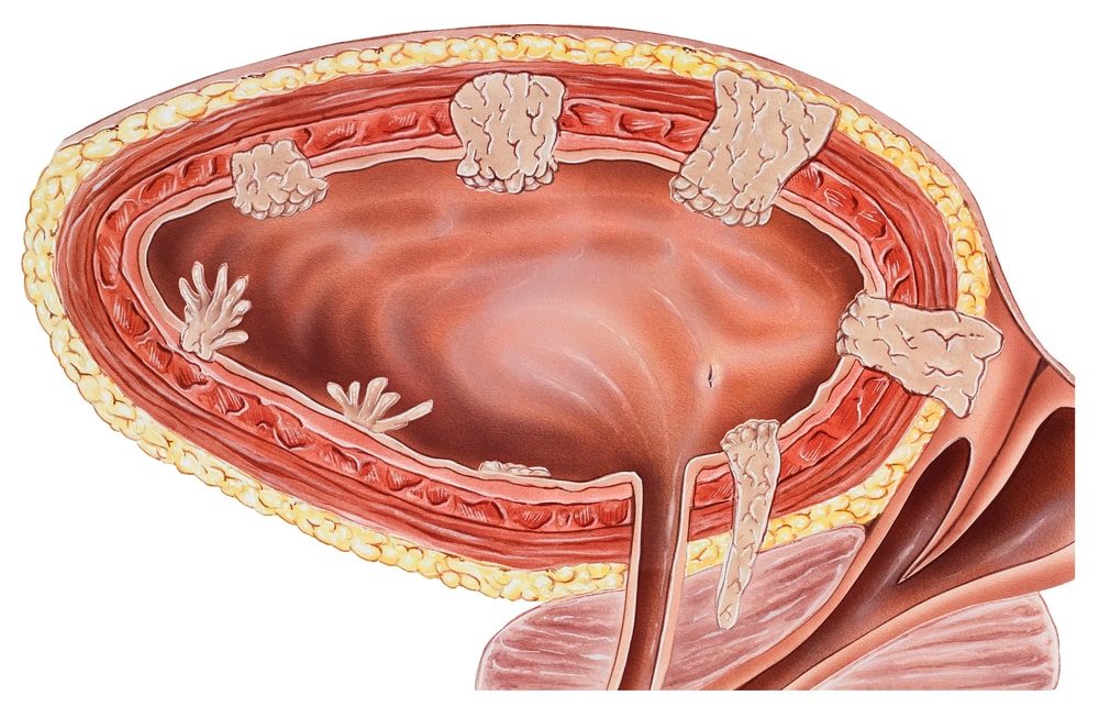 ayurvedic-treatment-for-bladder-cancer-urinary-bladder-cancer