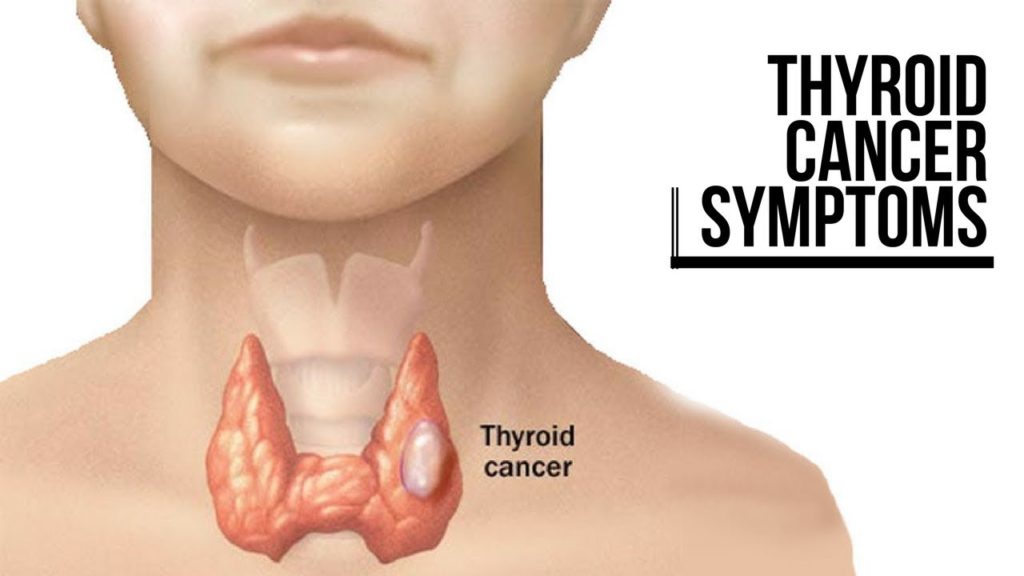 Thyroid Cancer Symptoms Types Causes And Treatment Overview