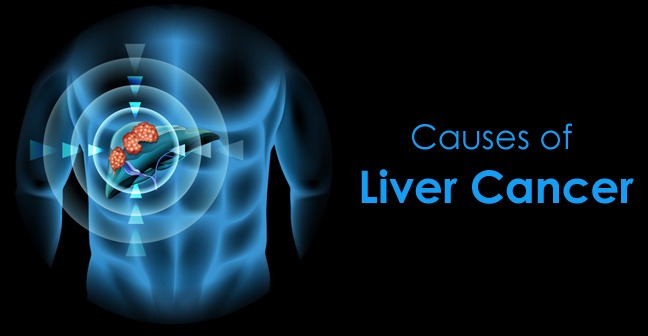 What is Liver Cancer? Diet and Nutrition for people living with Liver ...