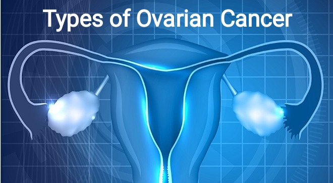 Ayurvedic Remedies For The Treatment For Ovarian Cancer